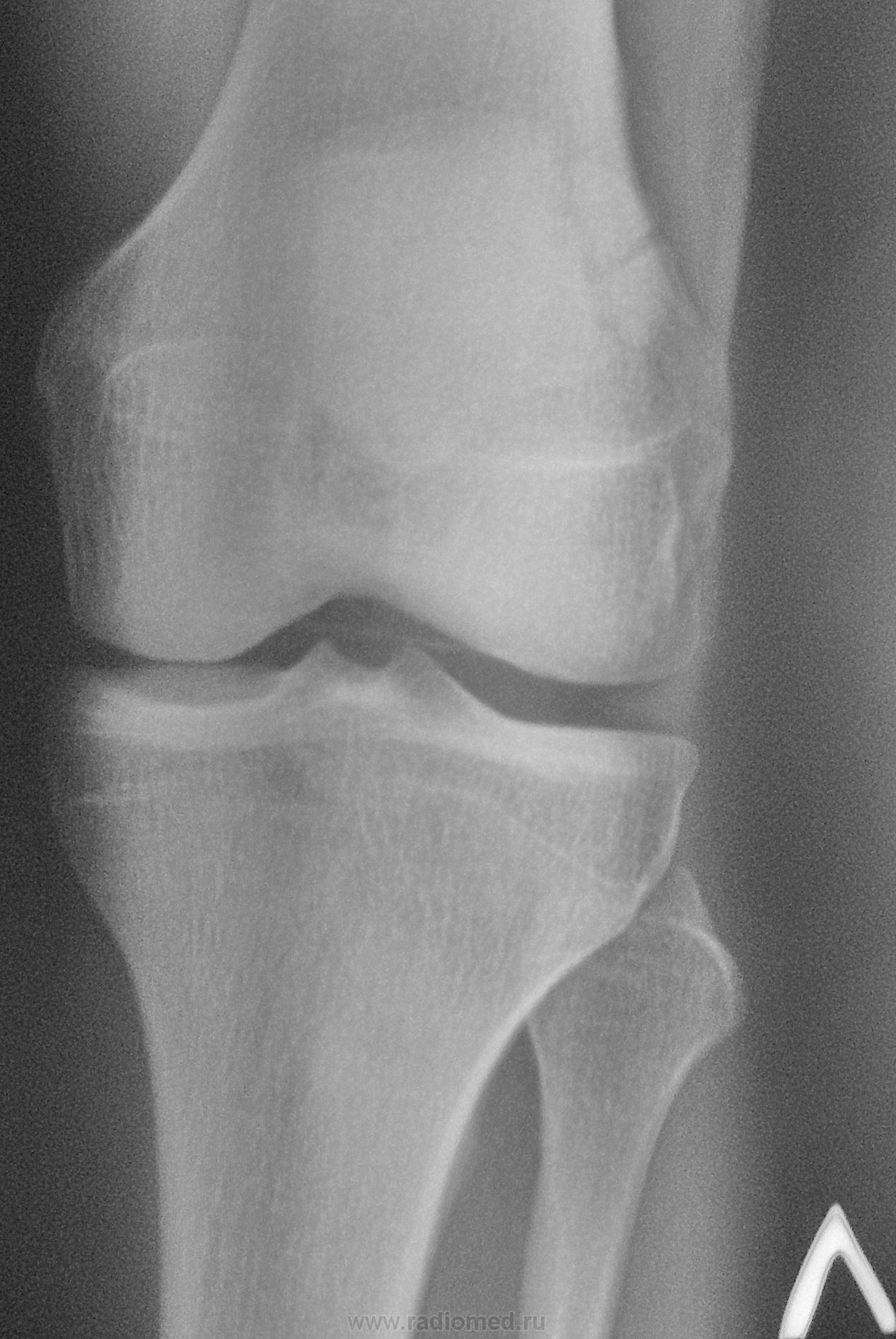 Перелом надколенника без смещения. Многооскольчатый перелом надколенника. Перелом надколенника рентген. Хондральный перелом надколенника. Надколенник коленного сустава перелом.