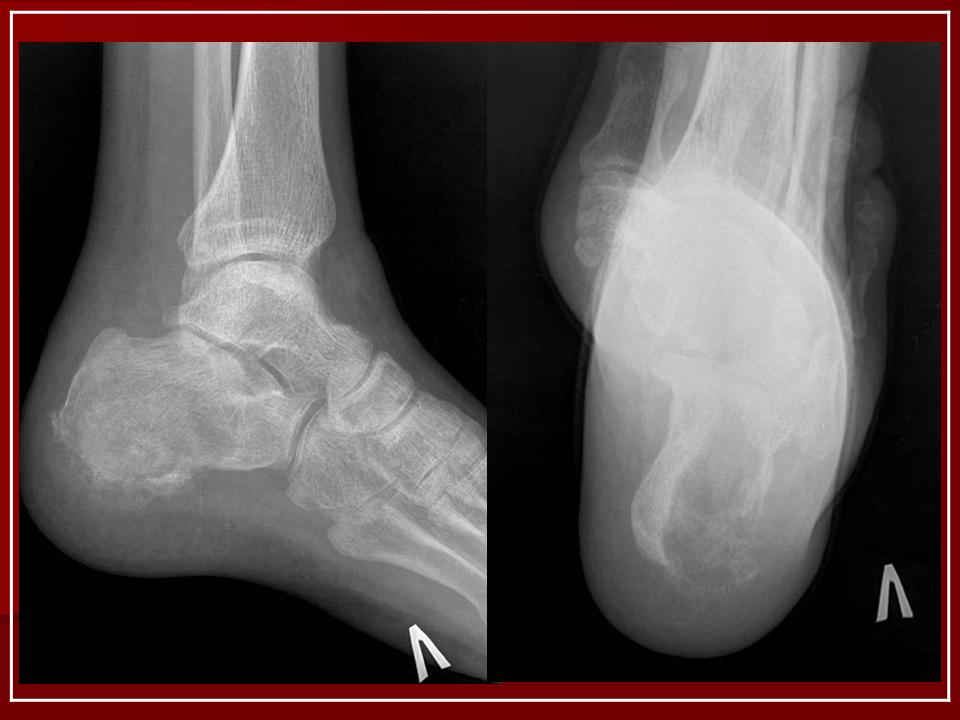 Хондросаркома. Хондросаркома пяточной кости.
