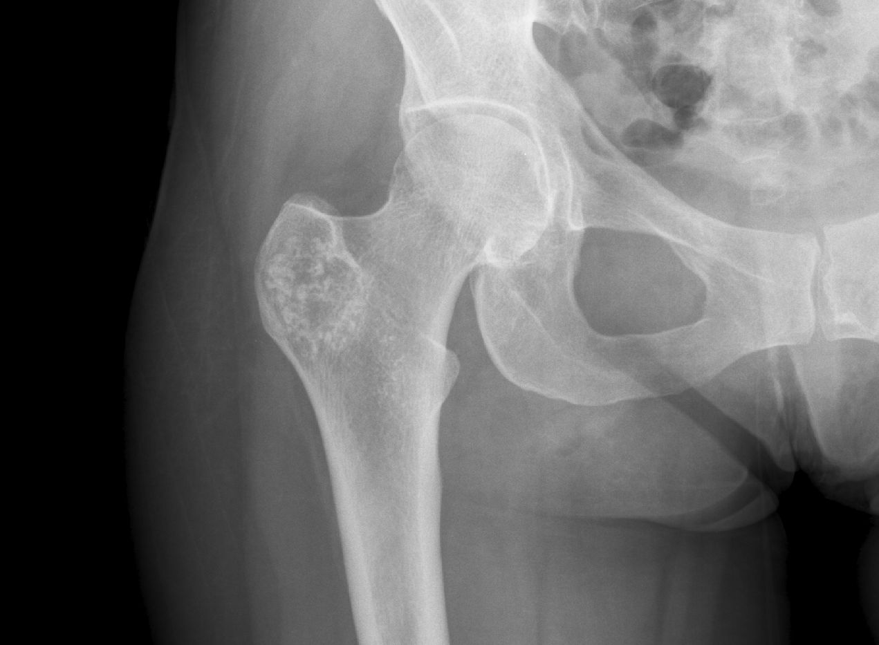 Рентген колена. Хондродисплазия рентген коленного. Рентген здорового коленного сустава. Пневмоартрография рентген коленного. Рентгеновский снимок сустава.