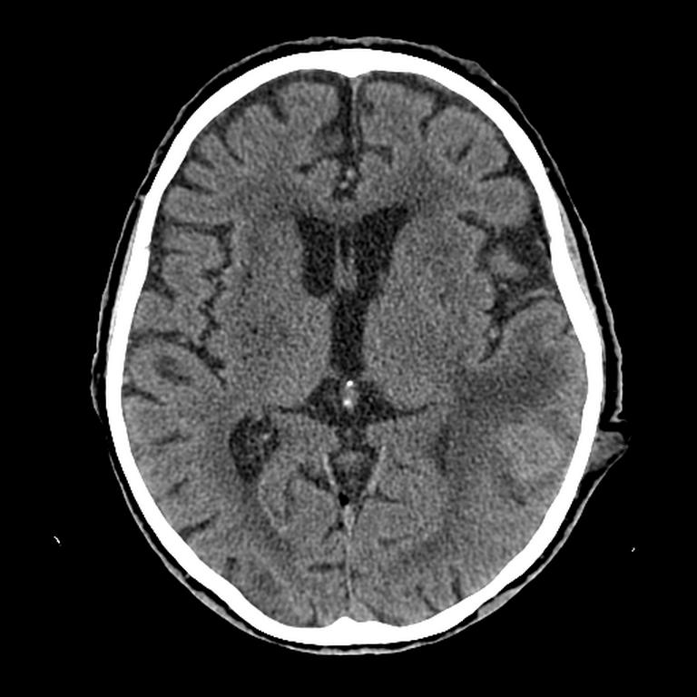 Кт головы стоя. Компьютерная томография головного мозга норма. Кт томограмма головного мозга. Компьютерная томография кт головного мозга. Туберкулома головного мозга кт.