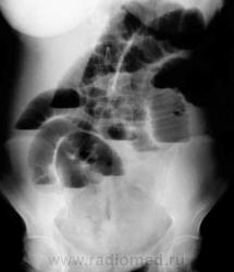 Высокая кишечная непроходимость рентгенограмма