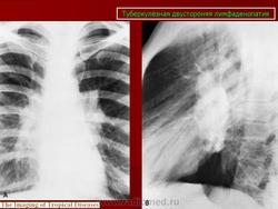 Туберкулез внутригрудных лимфатических узлов картинки