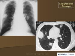 Отличие пневмонии от гранулематоза вегенера