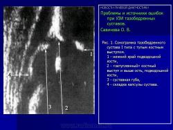 Ошибки при узи тазобедренных суставов