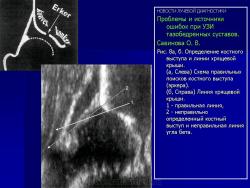 Ошибки при узи тазобедренных суставов