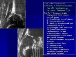 Ошибки при узи тазобедренных суставов