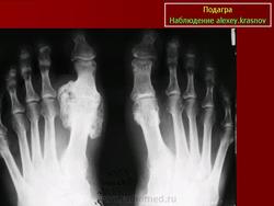 Рентгенологический симптом пробойника при подагре