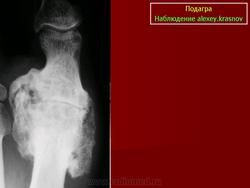 Симптом пробойника при подагре рентген
