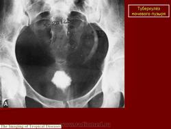 Мрт при туберкулезе мочевого пузыря