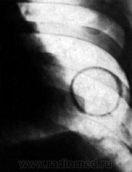 Синдром кольцевидной тени на рентгенограмме