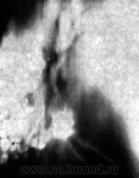 Синдром кольцевидной тени на рентгенограмме