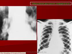 Туберкулез внутригрудных лимфатических узлов рентгенологические признаки