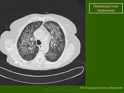 Картина рентгенологическая при пневмоцистной пневмонии