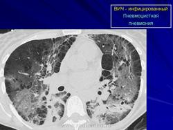 Пневмоцистная пневмония у вич рентген