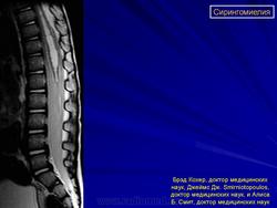 Сирингомиелия шейного и грудного отделов позвоночника мрт