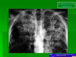 Пневмоцистная пневмония у вич рентген