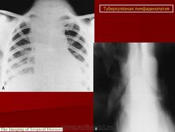 Туберкулез внутригрудных лимфатических узлов рентгенологические признаки thumbnail
