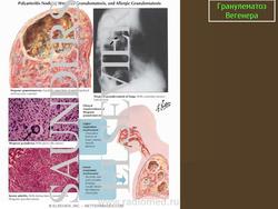 Отличие пневмонии от гранулематоза вегенера