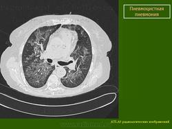Картина рентгенологическая при пневмоцистной пневмонии