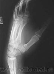 Рентгенограмма перелома ладьевидной кости