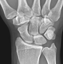 Рентген перелома запястья руки