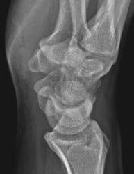 Переломы костей кисти рентгенограмма