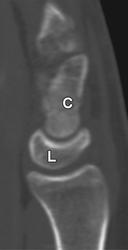 Рентгеновский снимок перелома запястья руки