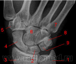 Переломы костей кисти рентгенограмма