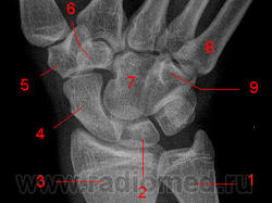 Рентген перелома запястья руки