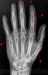 Рентгеновский снимок перелома запястья руки