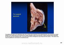 Остеохондрома коленного сустава описание после операции