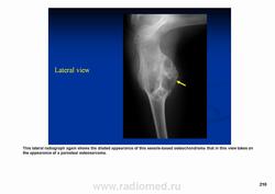 Остеохондрома коленного сустава описание после операции