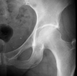 Перелом костей носа на рентгене