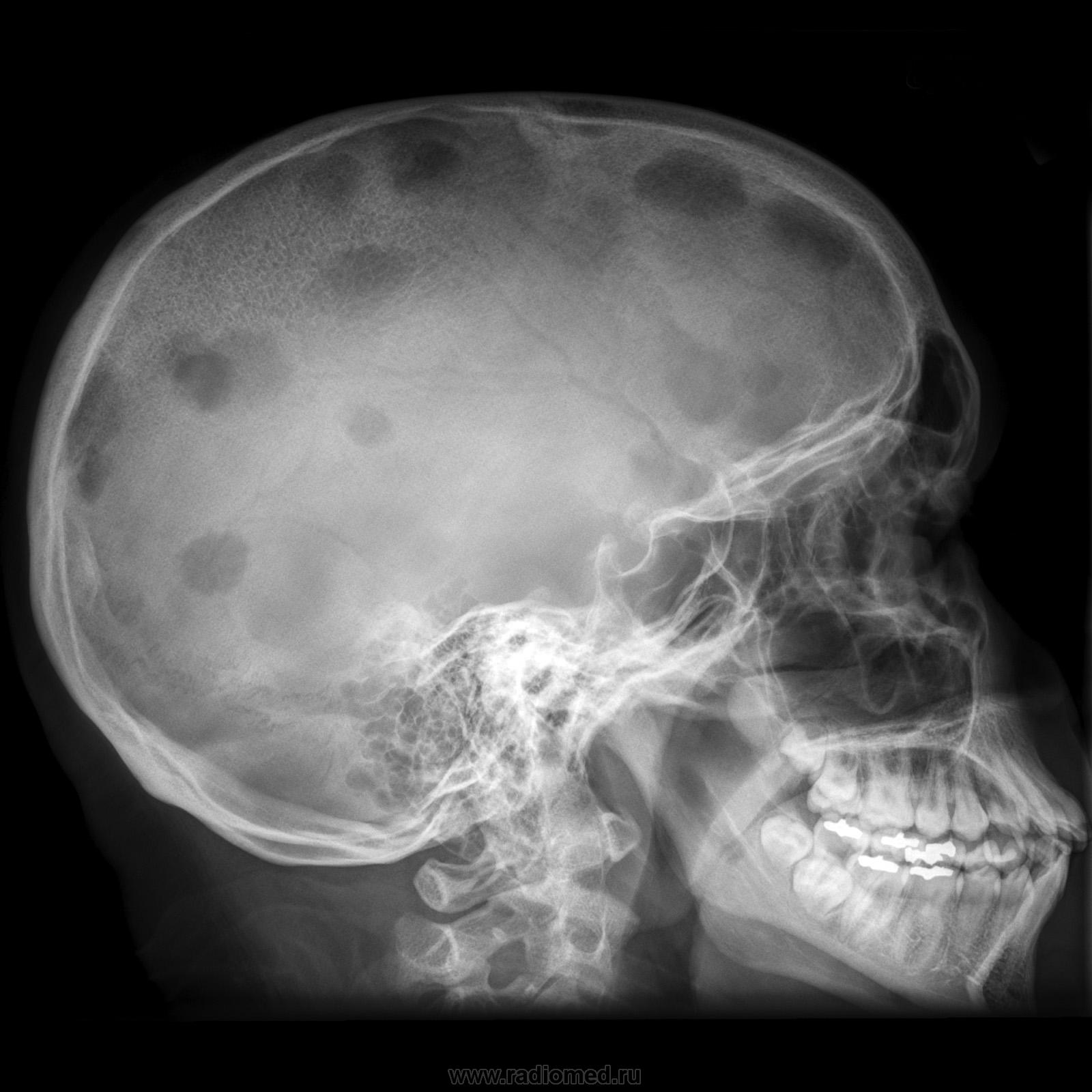 Множественные округлые. Остеома костей черепа кт. Миеломная болезнь рентген черепа. Эозинофильная гранулема костей черепа. Фиброзная дисплазия черепа рентген.