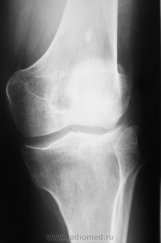 Коленный туберкулез. Синовиома коленного сустава рентген. Спейсер коленного сустава рентген. Туберкулез коленного сустава рентген. Артрит коленного сустава рентген.