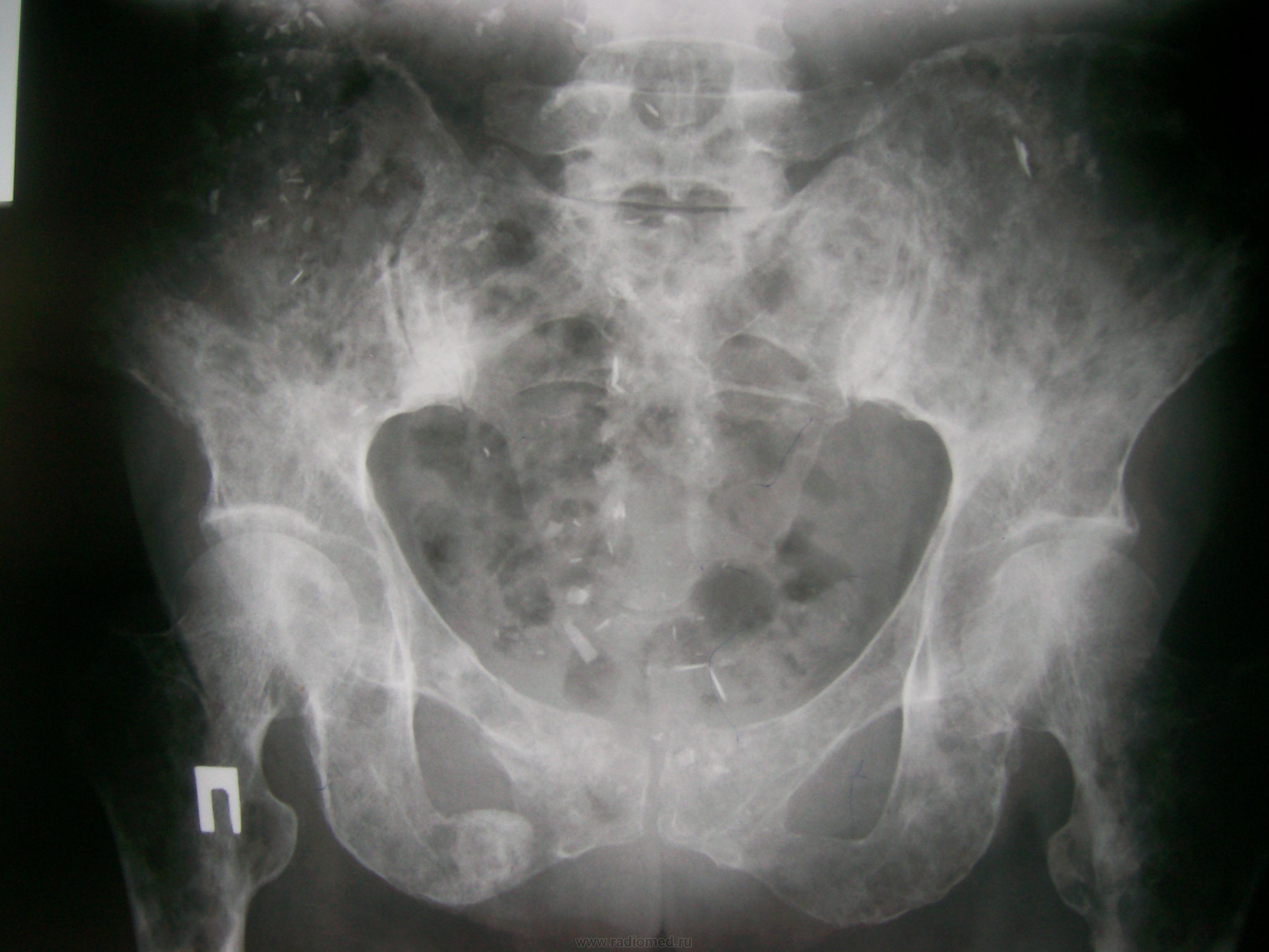 Миеломная болезнь тазовых костей рентген