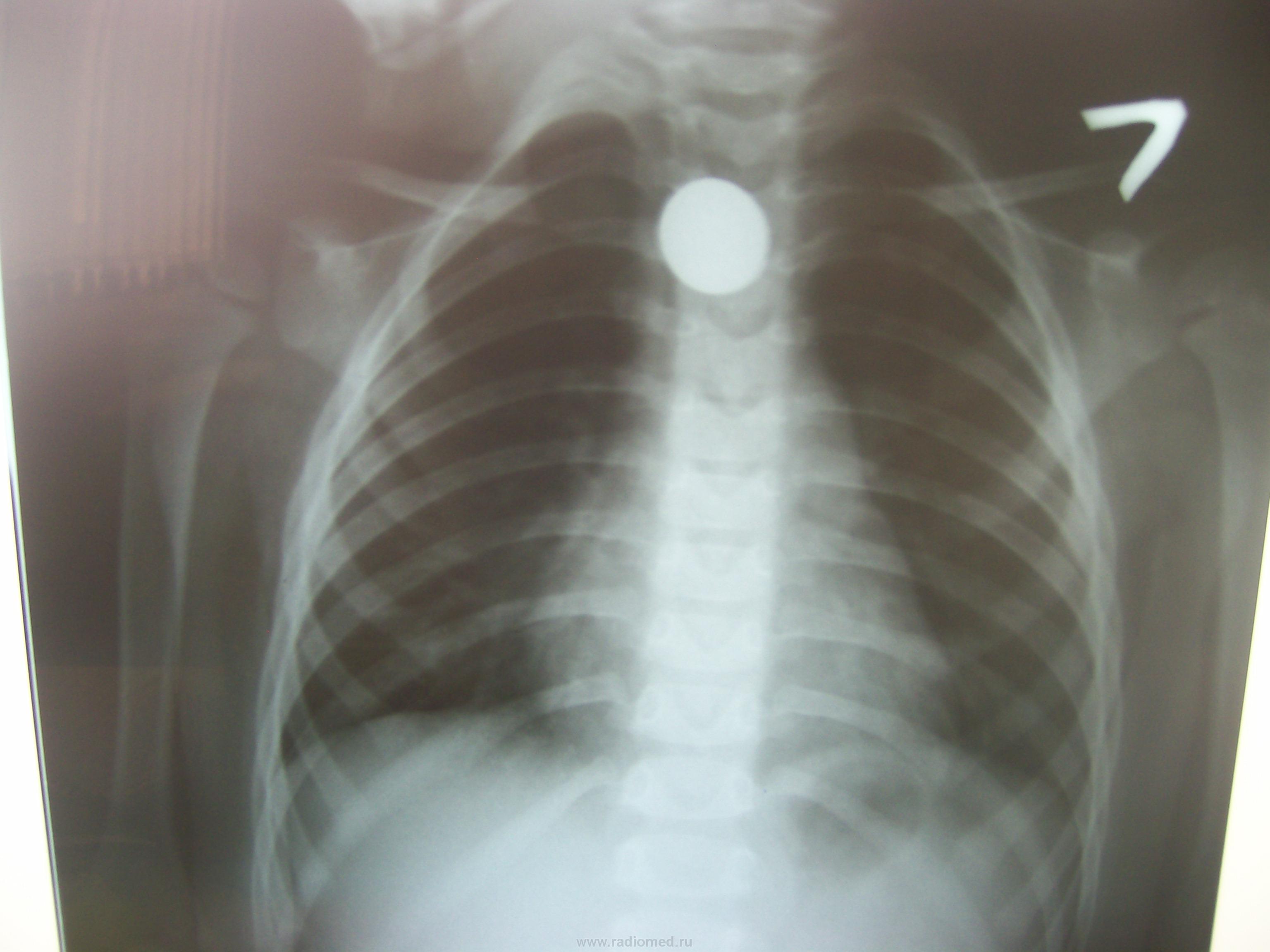 Инородное тело в дыхательных путях у ребенка рентген