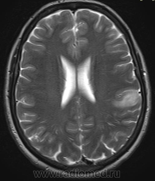 Fazekas. Лейкоареоз Фазекас. Лейкоареоз мрт. Лейкоареоз головного мозга мрт. Односторонний лейкоареоз головного мозга на мрт.