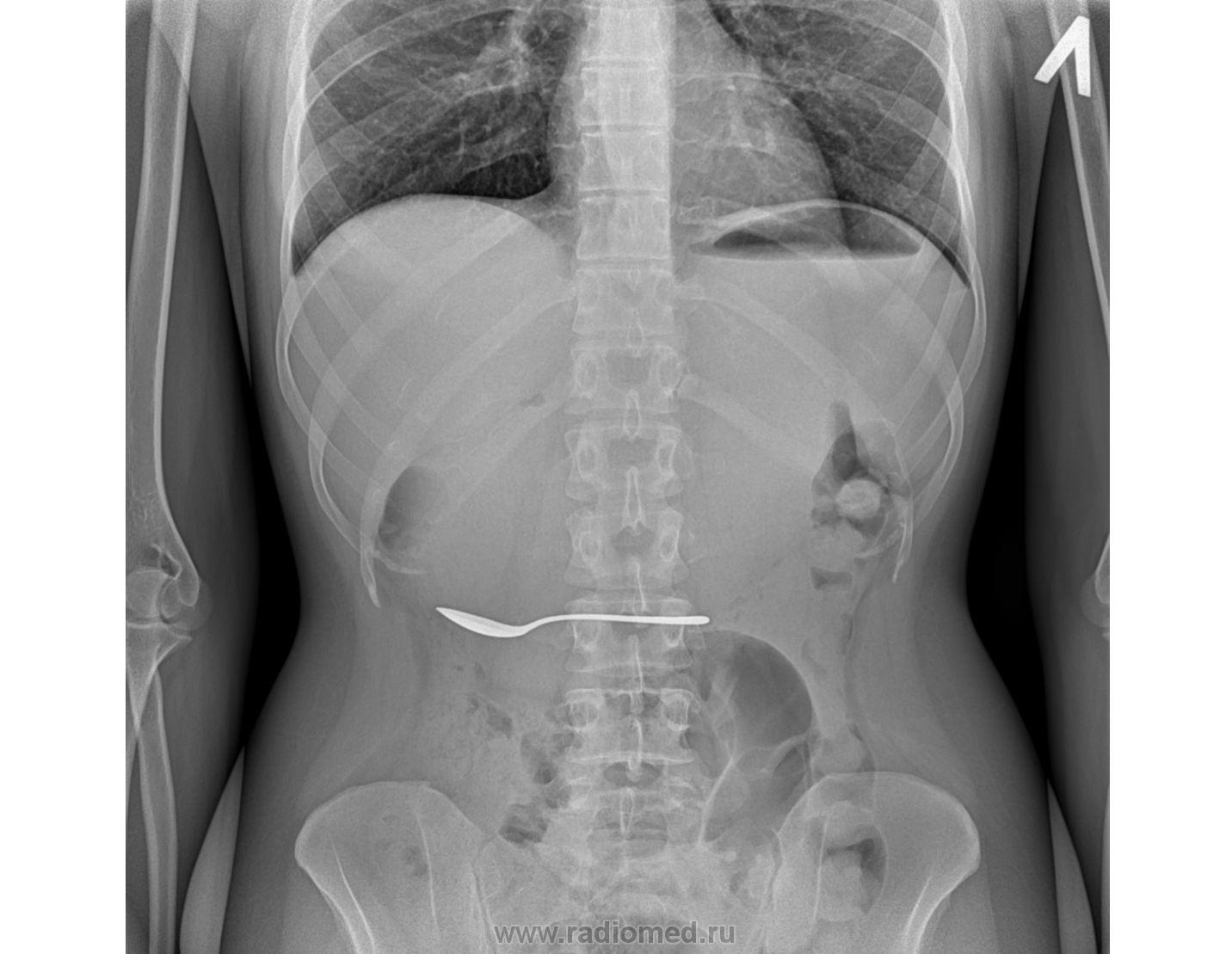 Инородное тело брюшной полости после операции. Рентген брюшной полости инородное тело. Рентгенограмма брюшной полости. Рентген брюшной полости снимки. Обзорная рентгенограмма живота.