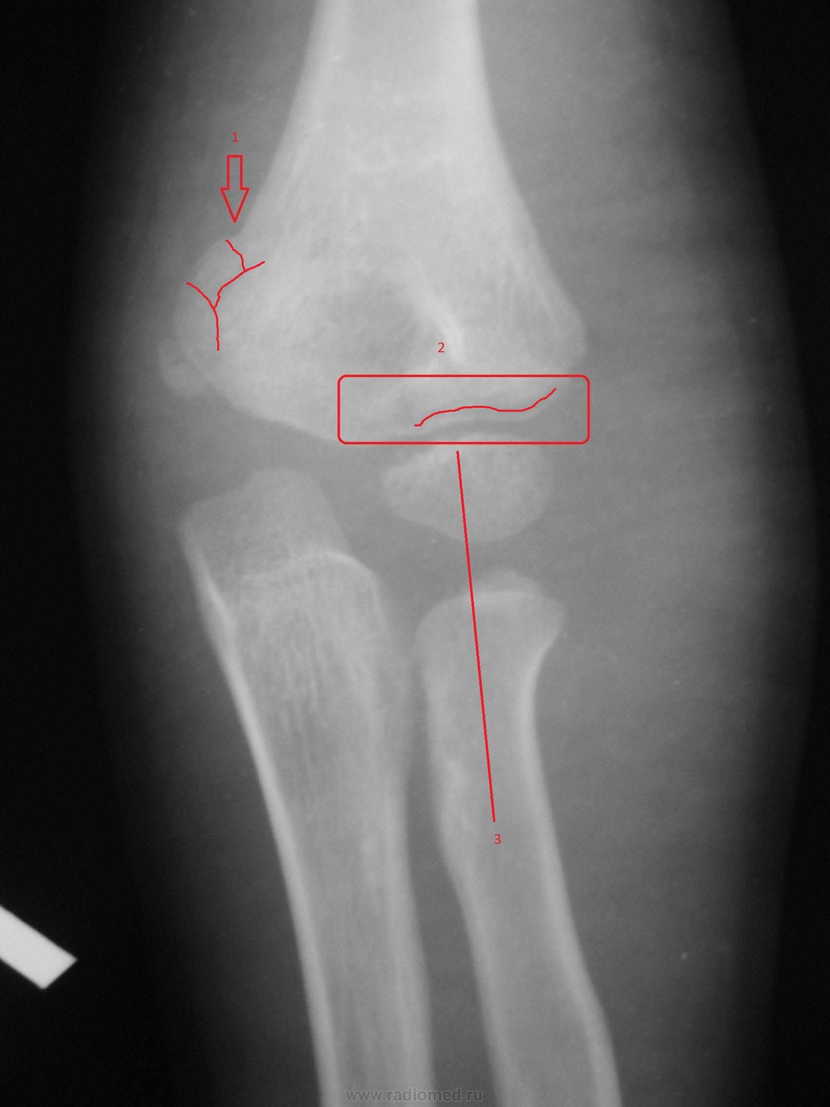 Локтевой сустав рентген норма