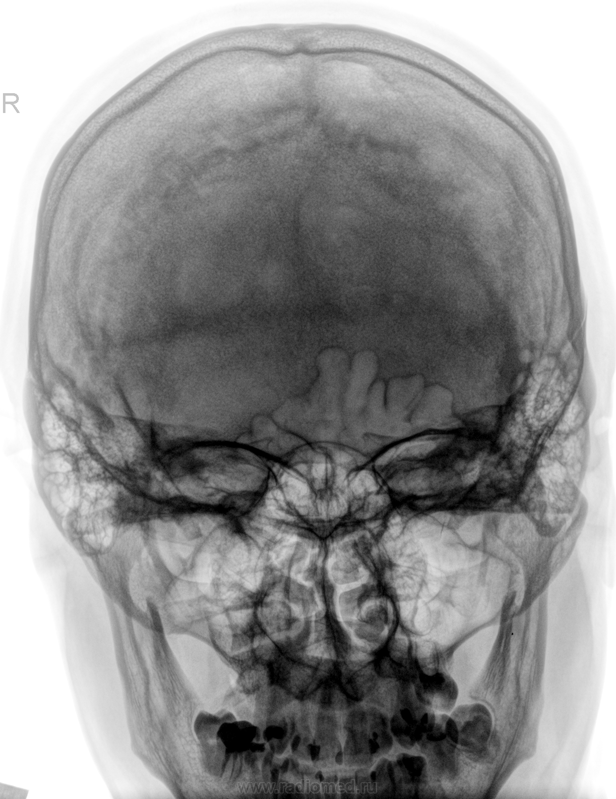 Рентген черепа. Обзорная рентгенография костей черепа. Пахионовы грануляции рентген черепа. Рентген черепа Кеннеди. Рентген черепа в 2-х проекциях норма.