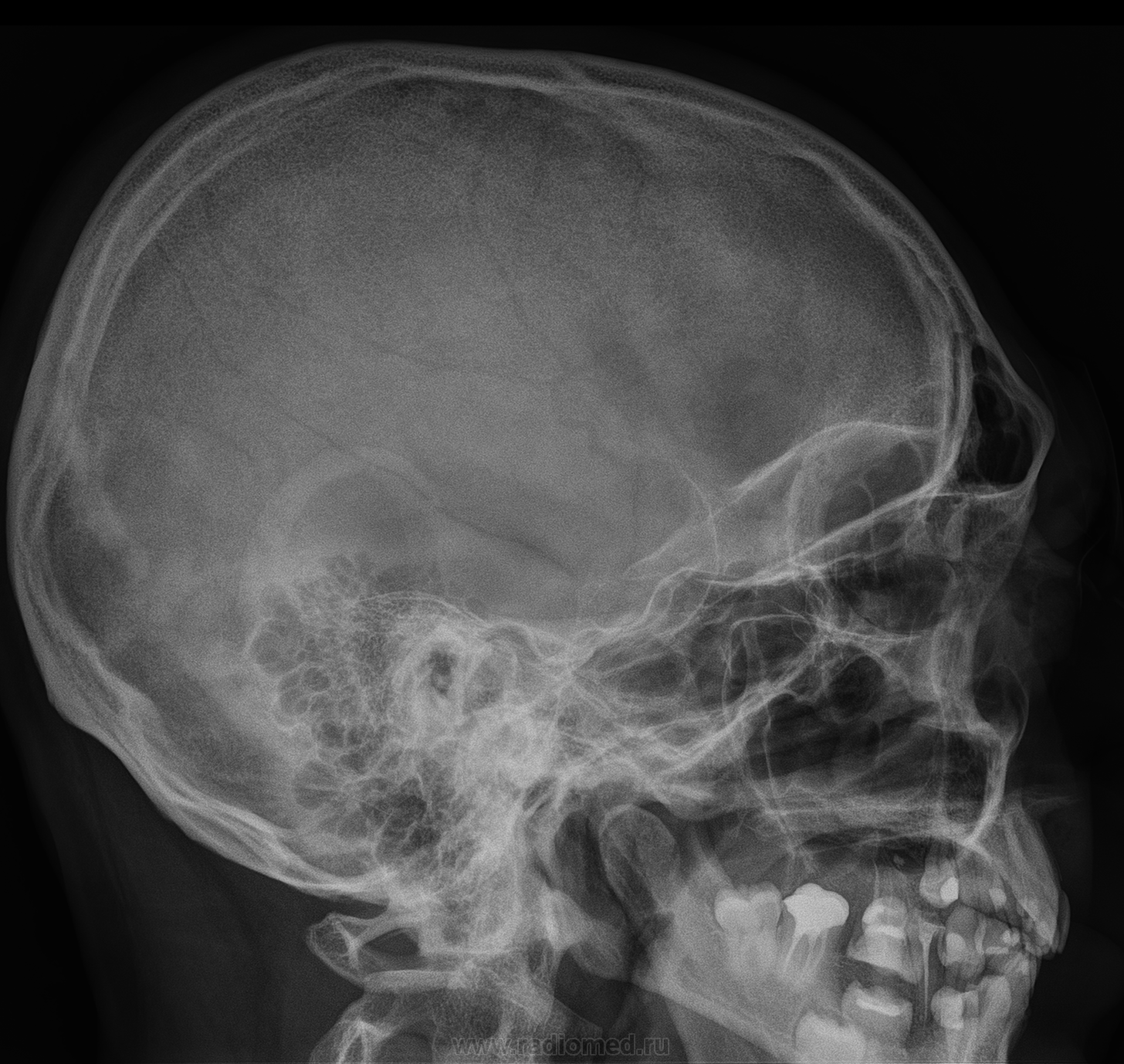Сотрясение кости. Рентгенография черепа (краниография. Височная кость черепа рентген. Снимок черепа сбоку рентген. Рентгеноанатомия костей черепа.