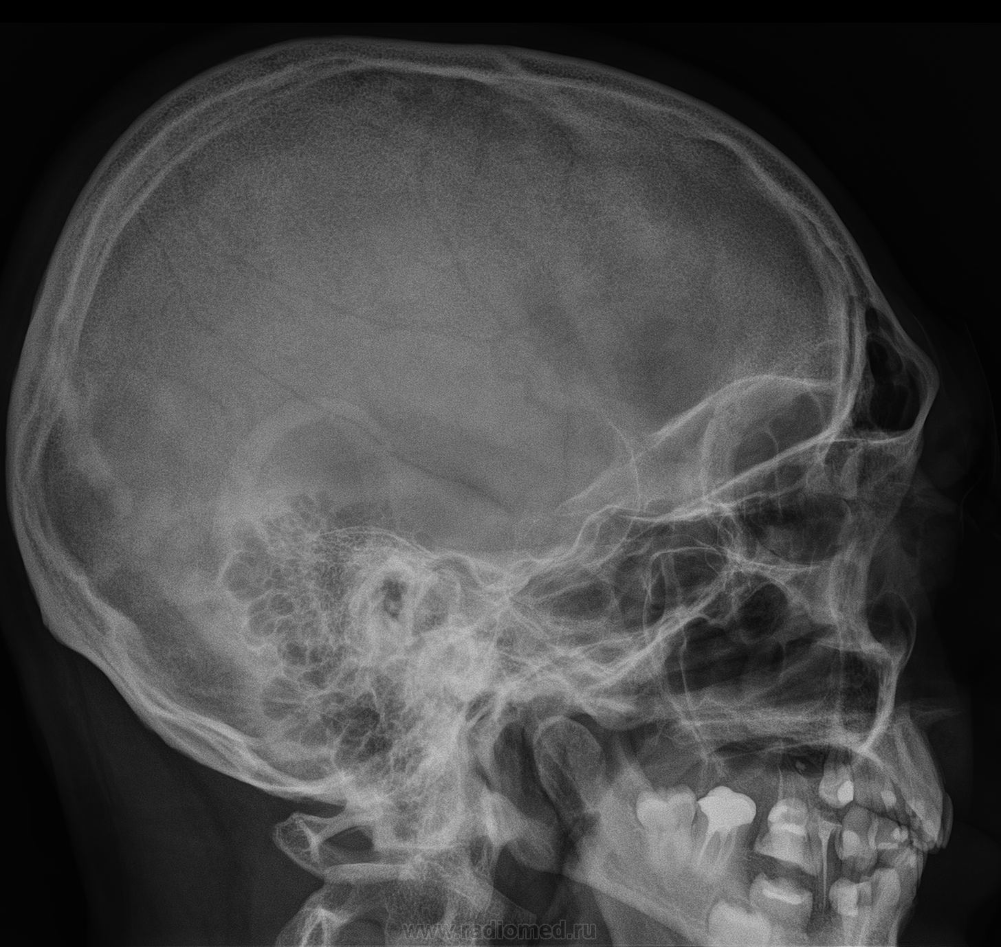 Рентгенография боковой проекции. Рентген снимок черепа сбоку. Рентгенография черепа (краниография. Рентген черепа височная кость. Кости черепа рентген норма.