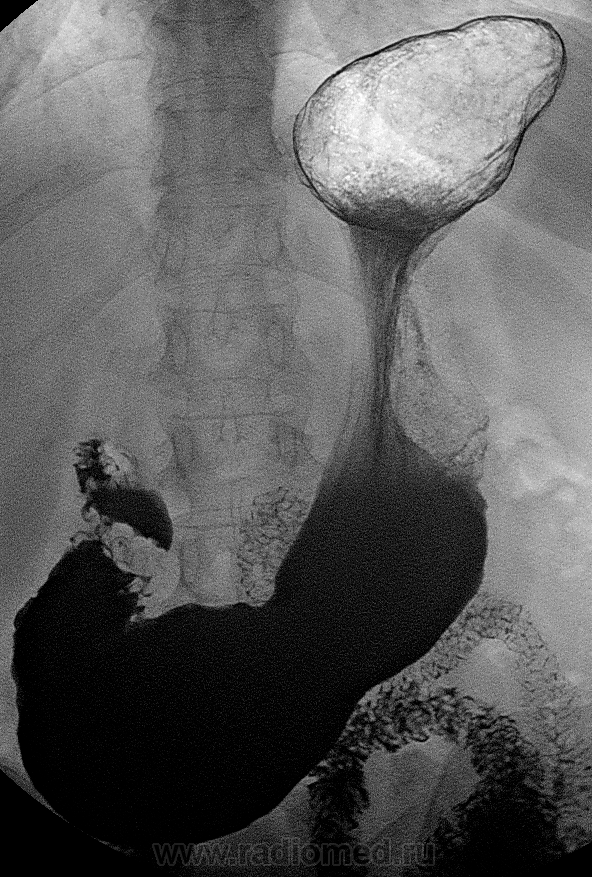Рентгеноскопия с барием подготовка. Рентгеноконтраст желудка. Рентген снимок желудка. Рентгенограмма желудка.