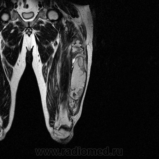 Мягкие ткани бедра. Мрт мягких тканей бедра. Образования мягких тканей бедра кт. Ангиосаркома мягких тканей бедра. Доброкачественное образование мягких тканей бедра.