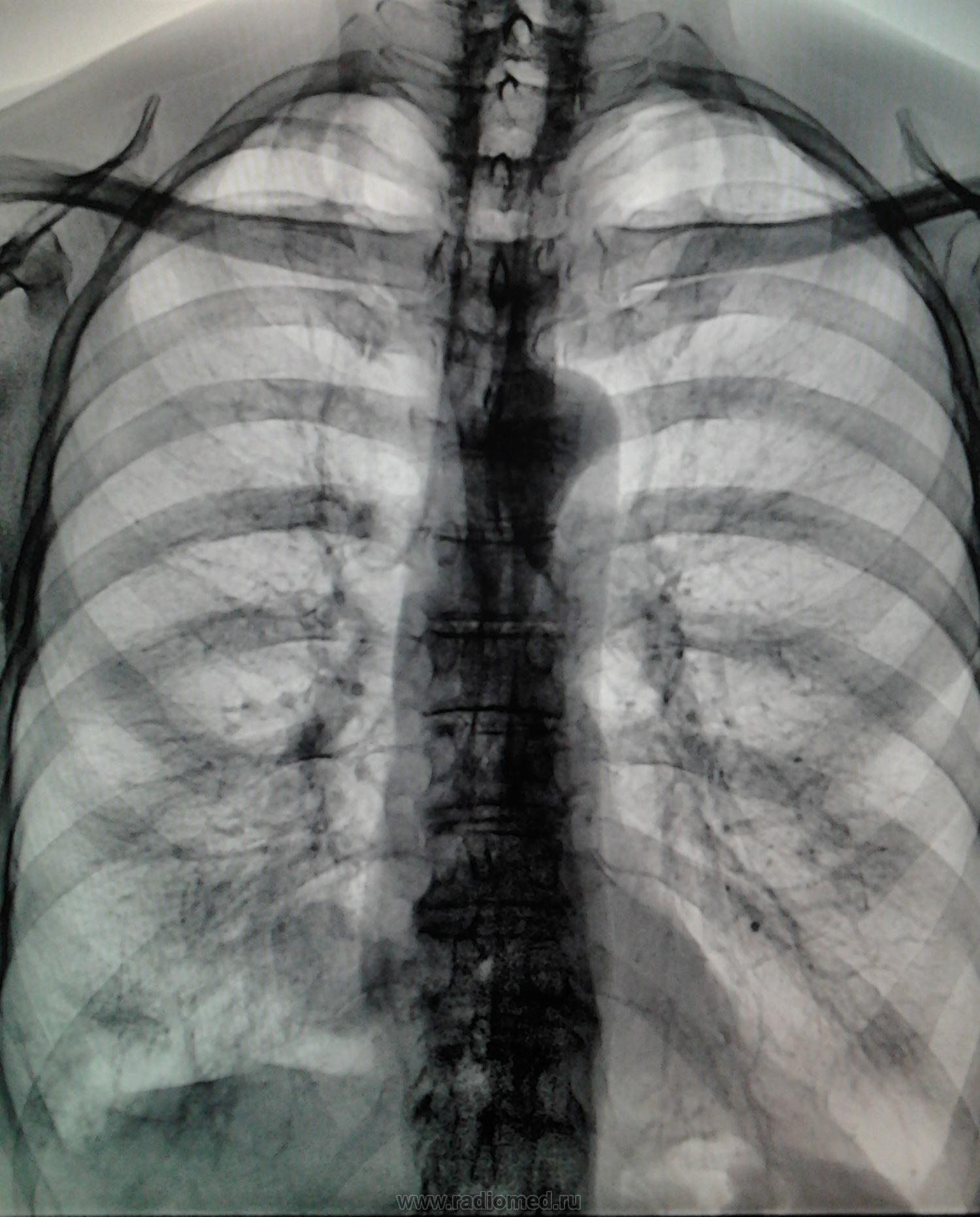Флюорография легких. Рентген легких курильщика. Рентген курящего человека. Лёгкие курильщика на рентгене. Эринген легких курильщика.