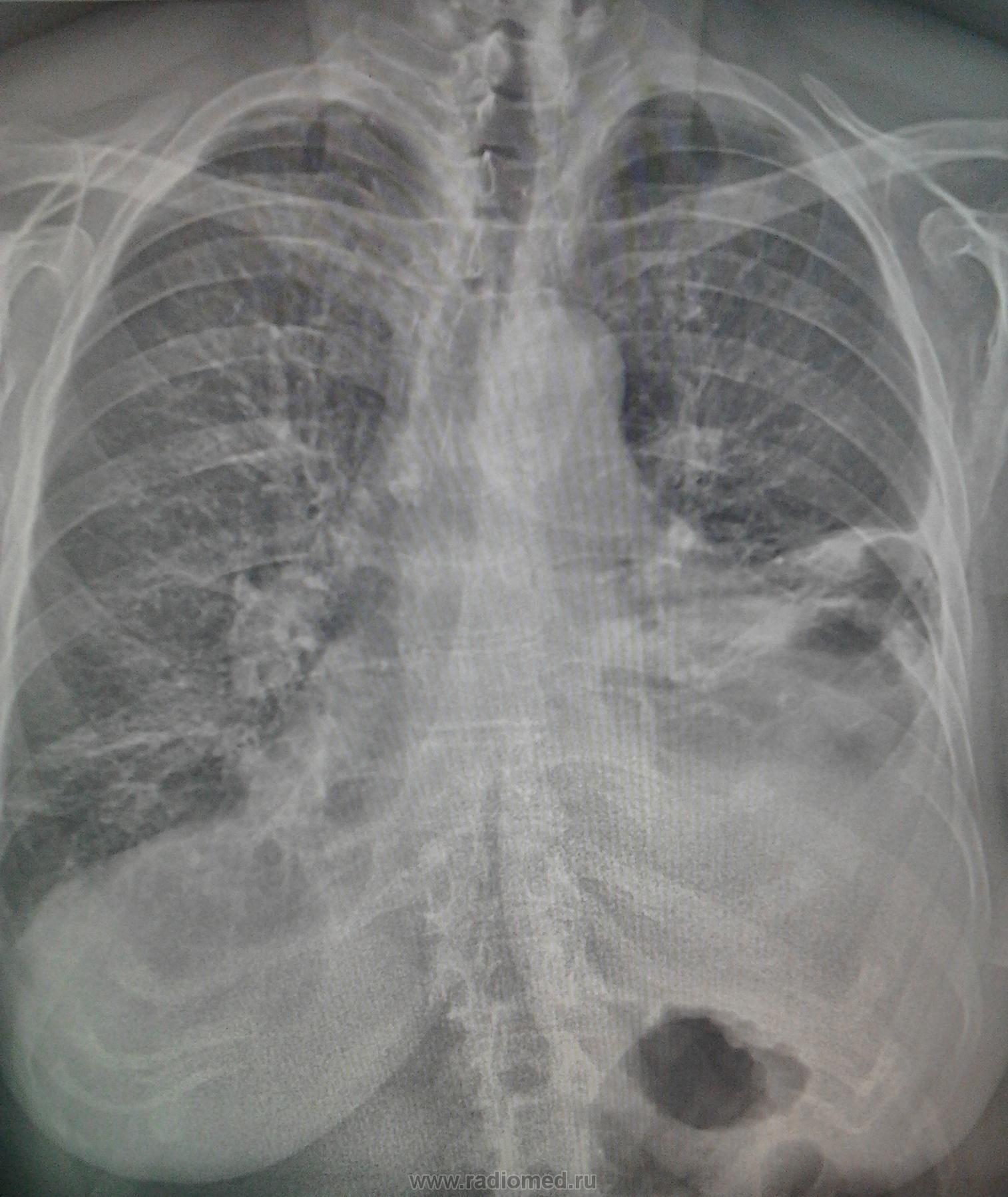 Ковидная пневмония на рентгене