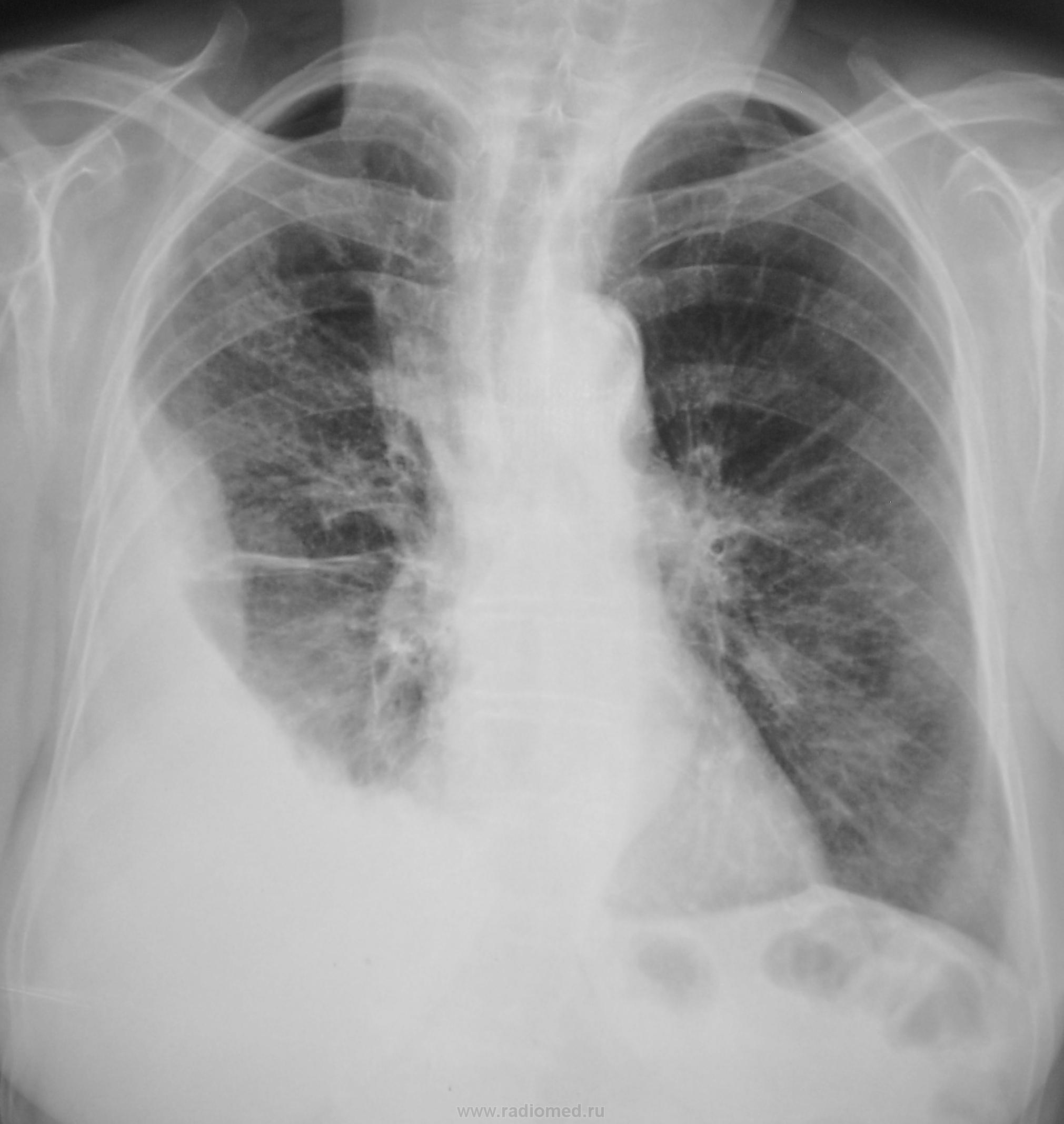 Рентген ОГК пневмония