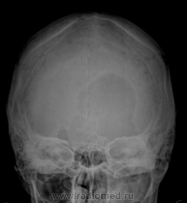 Трещина черепа у ребенка. Остеома теменной кости черепа рентген. Остеома лобной рентген. Остеома костей черепа рентген.
