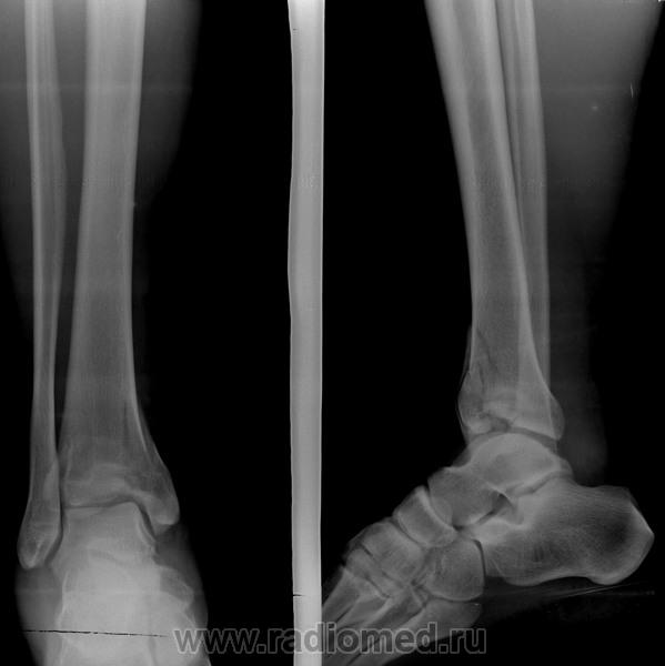 Голеностопный сустав левой ноги. Перелом берцовой кости рентген. Рентген берцовой кости норма. Винтообразный перелом голени рентген. Голеностопный сустав рентген норма.